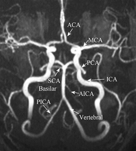 Circle Of Willis Mri Labeled