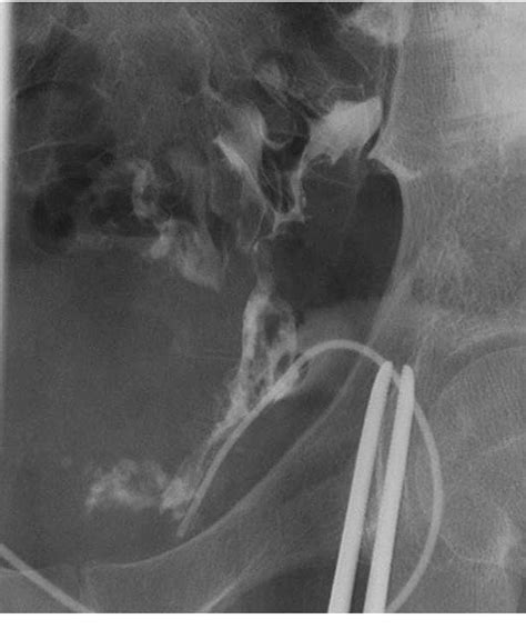 Figure 2 from Colocutaneous fistula after left inguinal hernia repair ...