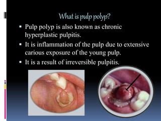 Chronic Hyperplastic Pulpitis