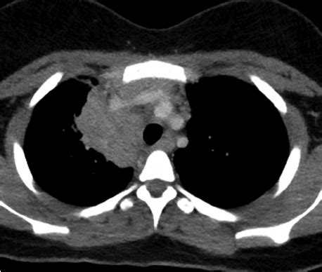 CT scan of the chest with contrast, demonstrating a mediastinal mass in... | Download Scientific ...