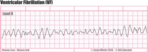 Matters of the Heart - V-fib — PatMac,RN