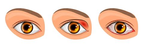 Viral Eye Infection: Types, Symptoms, Treatment | STD.GOV Blog