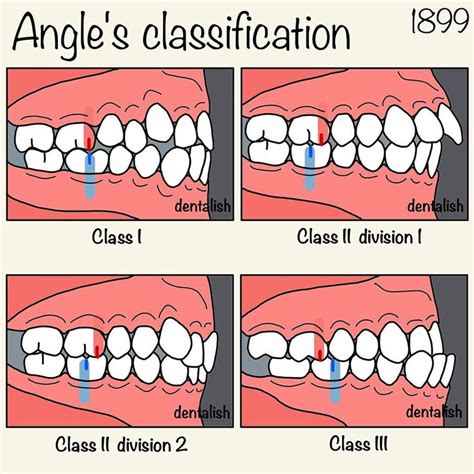 the stages of dental decay in an angle's classifiction, including teeth and gums