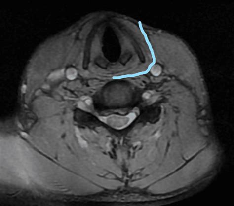 ACDF Complications - Dr. Gilete