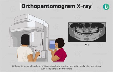 Orthopantomogram (OPG) X-ray: Procedure, Purpose, Results, Normal Range, Cost, Price, Online Booking