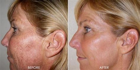 Laser Treatments - Dr Monica Scheel Dermatology, Kailua-Kona, HI