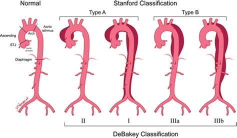 Aortic Dissection and Other Acute Aortic Syndromes: Diagnostic Imaging Findings from Acute to ...