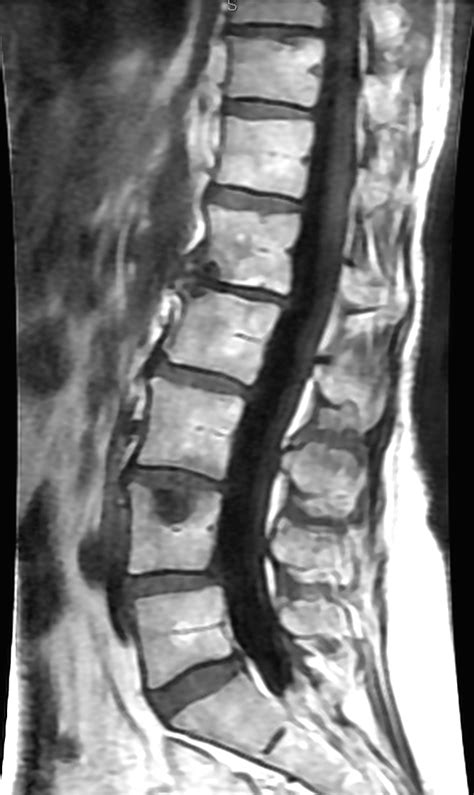 Healthcare Extreme How To Read An MRI Lumbar Spine In 8 Easy Steps