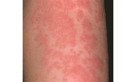 Urticaria (Hives or Angioedema) info | Skin & Hair problems articles | Body & Health Conditions ...