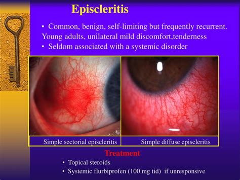 Episcleritis Vs Scleritis