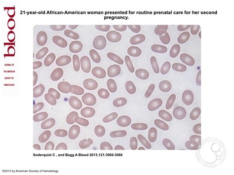 Hereditary elliptocytosis