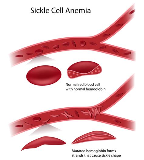 Sickle cell disease: MedlinePlus Genetics