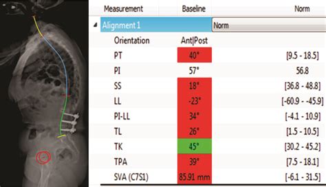 Factors Influencing Sagittal Malalignment and its Effect on Clinical Implications in Adult ...