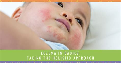 Eczema In Babies - Taking The Holistic Approach