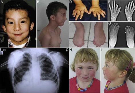 Carpenter syndrome causes, symptoms, diagnosis, treatment & life expectancy