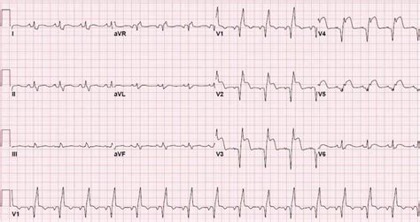 Anterior Wall ST elevation MI with RBBB ECG (Example 2) | Learn the Heart