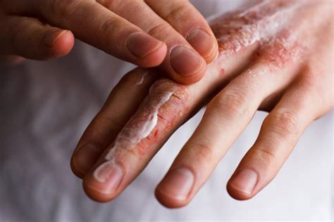 Epidermolytic Ichthyosis Symptoms and Treatment: Hines Dermatology Associates Inc.: Dermatology