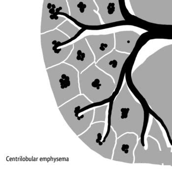 Emphysema - Causes, Signs, Symptoms, Stages, Expectancy & Treatment