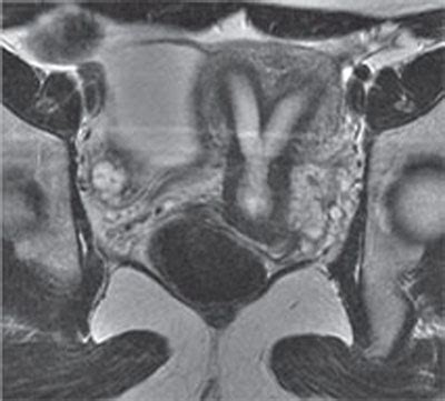 136 Bicornuate Uterus | Radiology Key