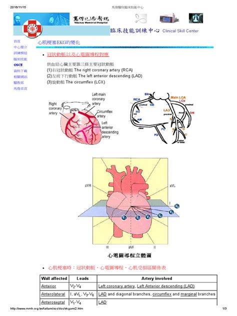 MI EKG finding