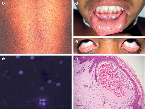 Fabry disease causes, symptoms, life expectancy, diagnosis and treatment