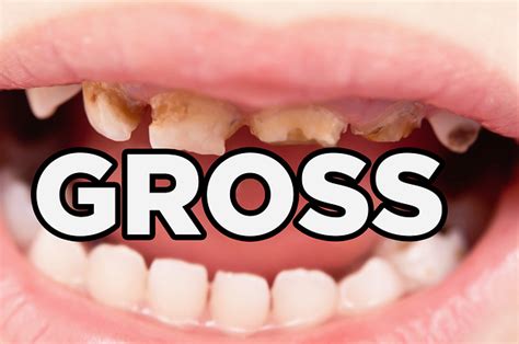 11 Gross Facts About Your Teeth