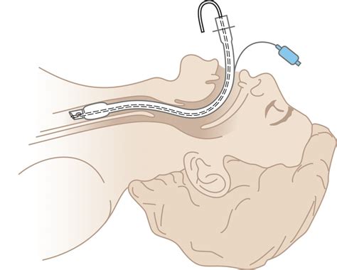 Endotracheal Tube Holder