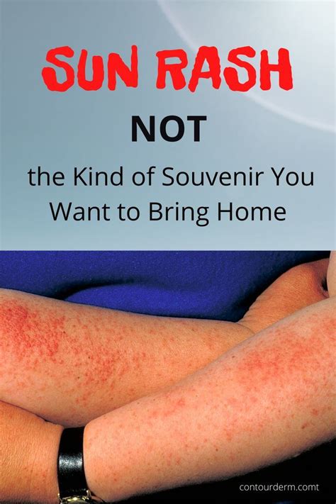 SUN RASH – Not the Kind of Souvenir You want to Bring Home! | Contour Dermatology in 2021 | Rash ...