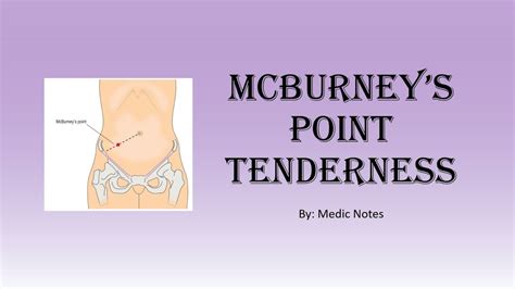 Mcburney's point tenderness - YouTube