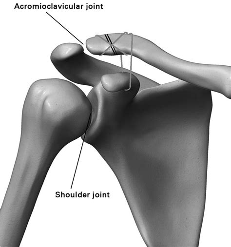 Under-coracoid-around-clavicle (UCAC) loop in type II distal clavicle fractures | Bone & Joint