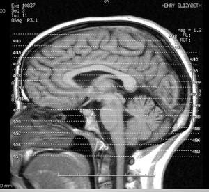 Brain stem injury | General center | SteadyHealth.com