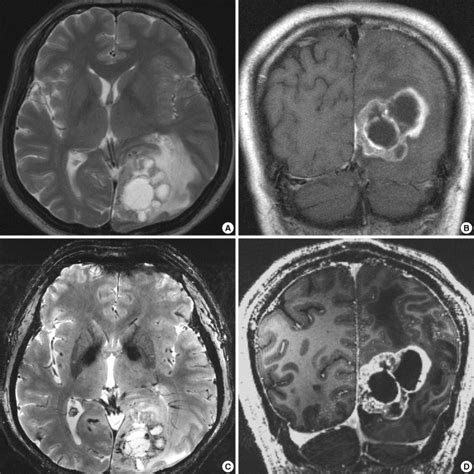 1.5T and 7.0T MRI for metastatic brain tumor of non-small cell lung... | Download Scientific Diagram