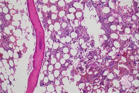 Panel A, 10X: Focal area of epithelioid cells in bone marrow core biopsy