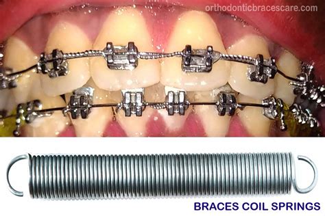 Broken Braces Coil Spring: How To Fix, Why This Happens - Orthodontic Braces Care