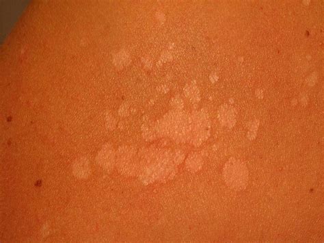 Tinea Versicolor: Causes, Diagnosis, and Treatment - Verywell Health