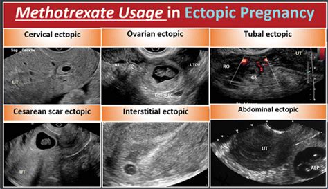 Methotrexate Injection For Ectopic Pregnancy