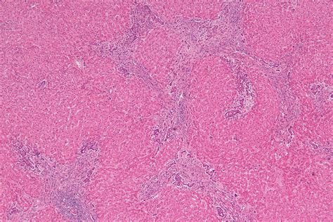 Focal Nodular Hyperplasia; Hyperplasia, Focal Nodular