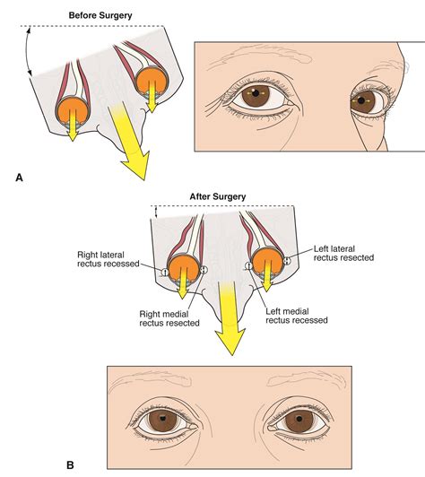 Infantile Idiopathic Nystagmus: for professionals - Gene Vision