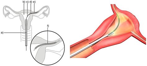 Removal Of Essure Contraceptive Device