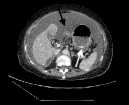 Lesser Sac Ultrasound