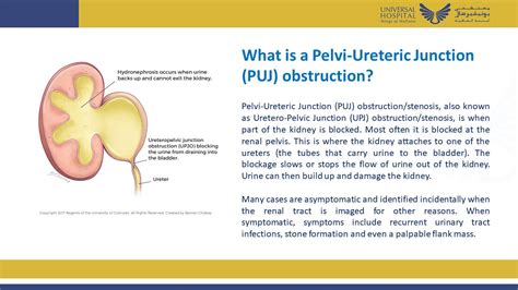 Successful A-H Pyeloplasty for PUJ Obstruction in a Duplex Kidney - Dr. Tomson Thomas ...