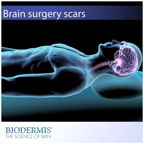 Brain Surgery Scar Care | Biodermis.com