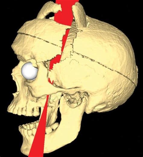 The bizarre story of how a railroad worker survived an iron rod which went through his skull ...