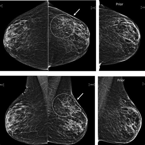 -Current bilateral screening mammogram (left images) showing skin... | Download Scientific Diagram