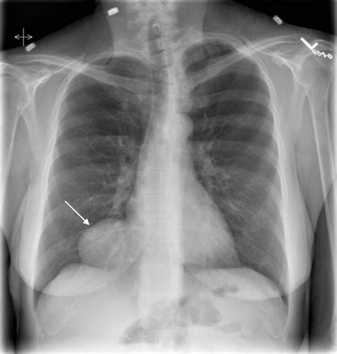 Image Diagnosis: Pericardial Cyst The Permanente Journal, 55% OFF