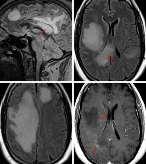 Tumefactive Demyelination | The Neurosurgical Atlas