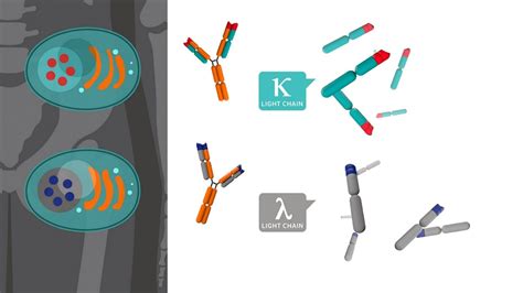 Evaluating MGUS with Free Light Chain Assays in Clinical Practice ...