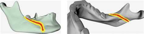 Sagittal split osteotomy line specified onto the three-dimensional... | Download Scientific Diagram