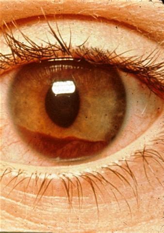 Hyphema - Cancer Therapy Advisor