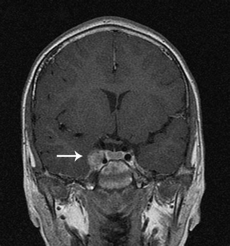 Cavernous Sinus Thrombosis (CST) - Stepwards